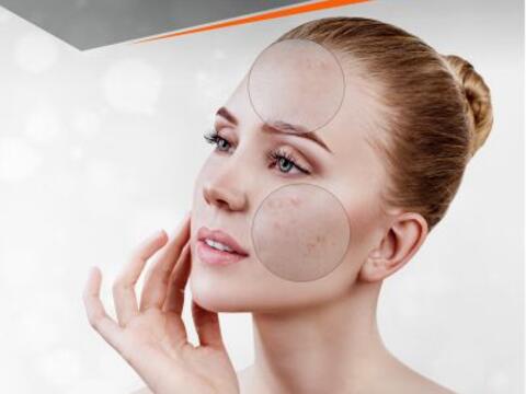 Behandlung von unreiner Haut bei Kosmetik Oppenheimer