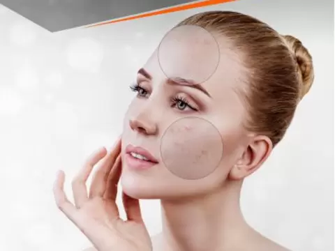 Behandlung von unreiner Haut bei Kosmetik Oppenheimer
